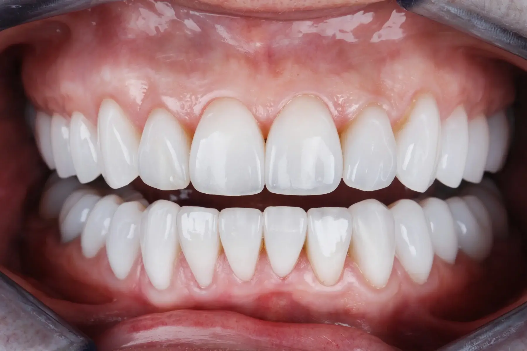 Close-up of a smile after dental treatment