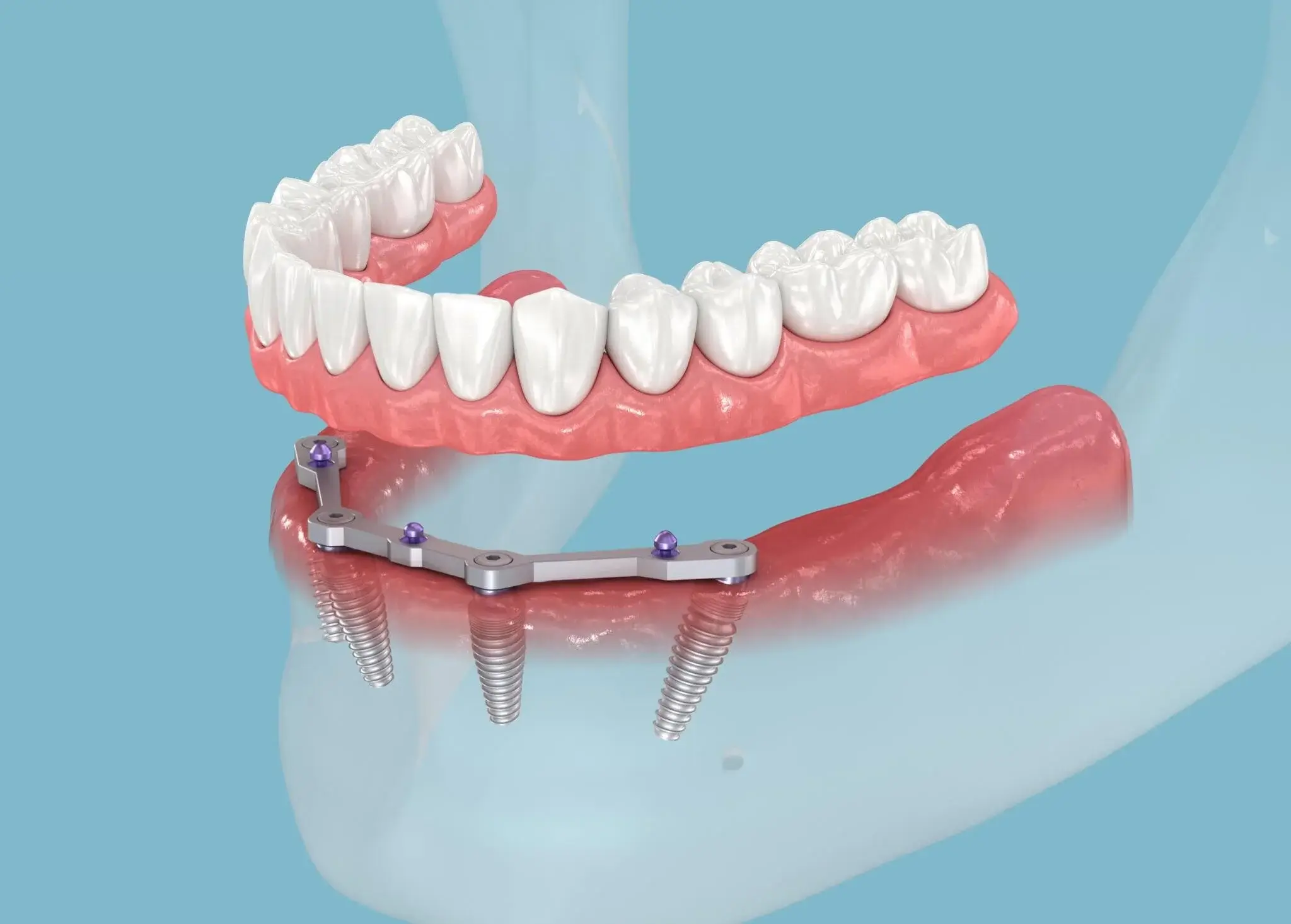 3D illustration of an All-on-4 dental implant treatment on the lower jaw