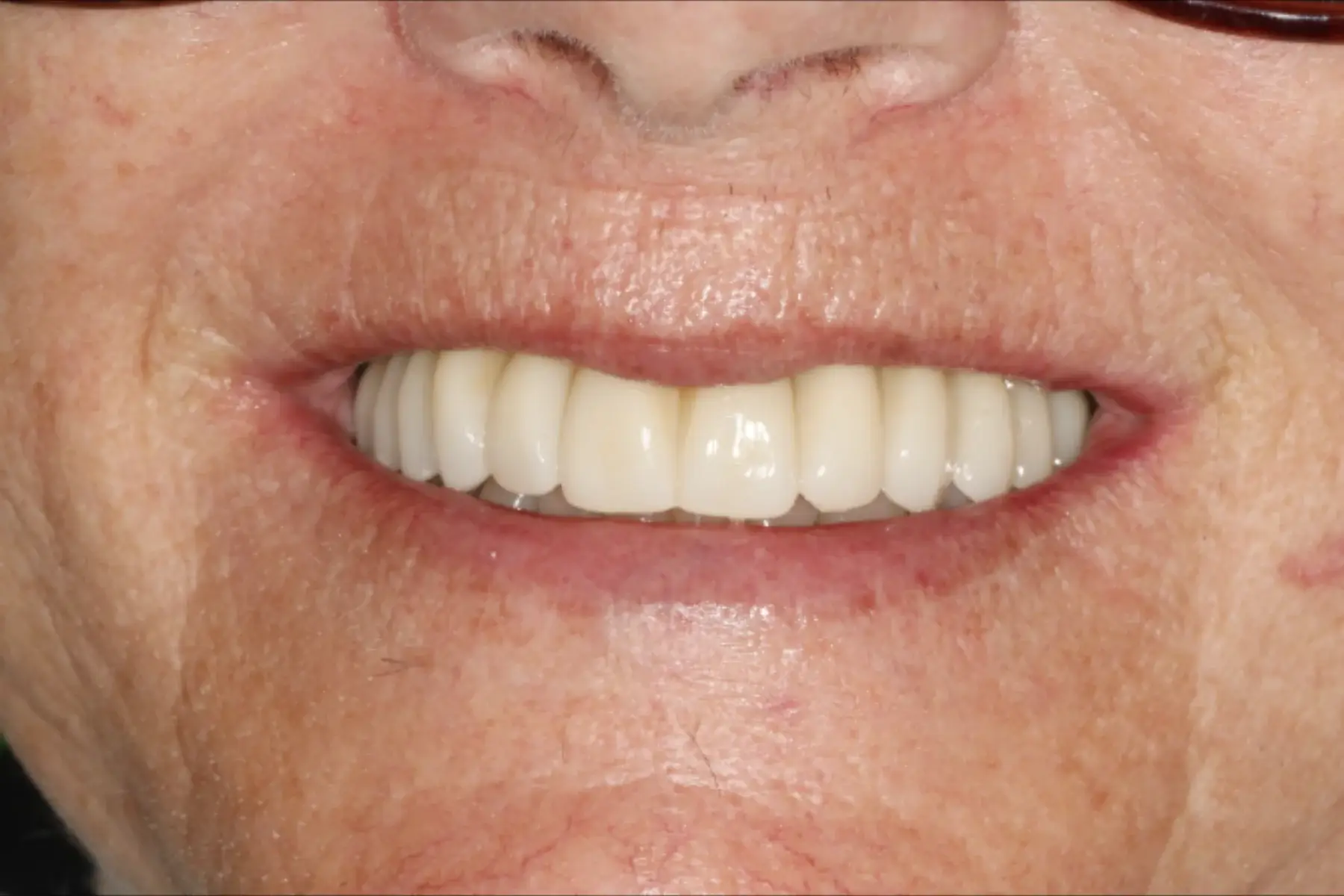 All-on-4 dental implant treatment at Mia Dental Centre